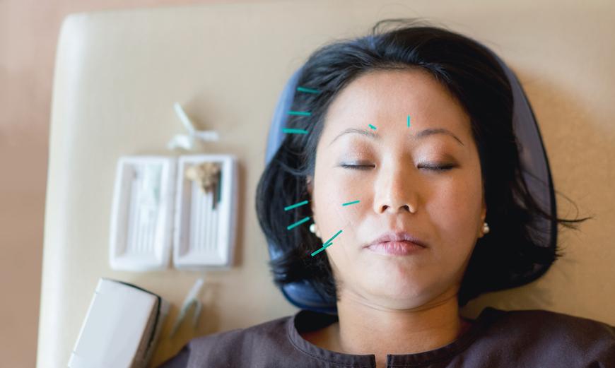 facial acupuncture in a relaxed environment