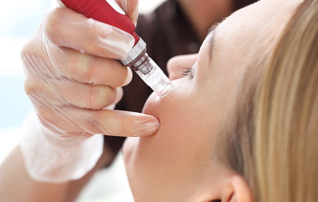 a person receives microneedling